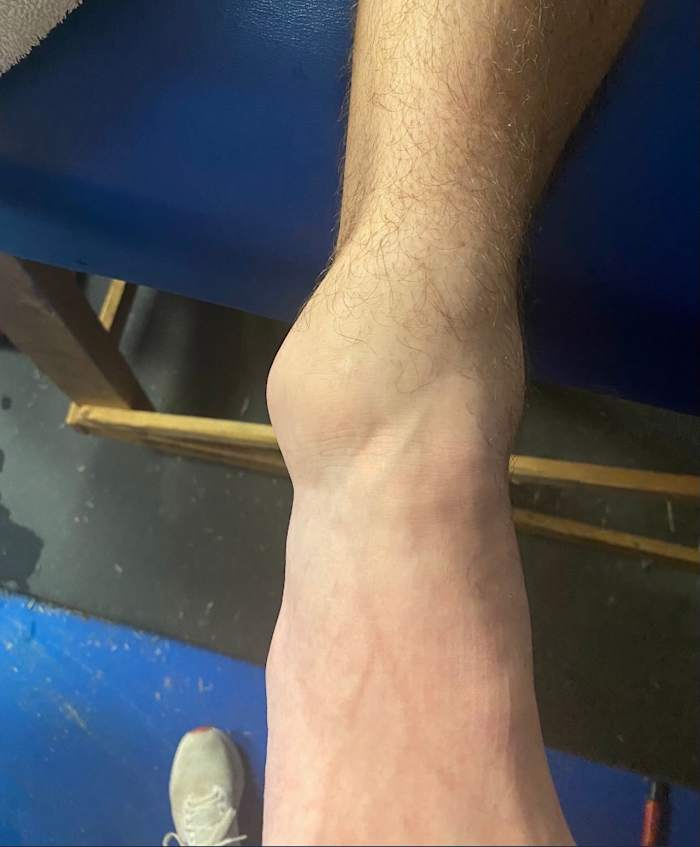 Ty Simpson’s ankle in a picture he sent the day before Westview’s playoff game at South Gibson.